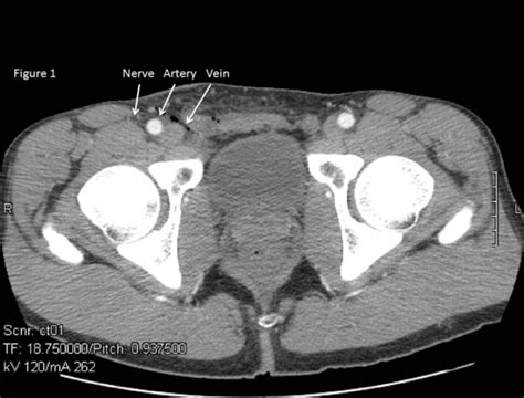 Figure 1 The Relationship Of The Femoral Nerve Femoral Artery And