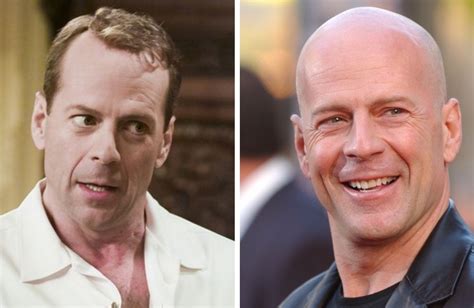 Bald Celebrities Before After Embracing Baldness