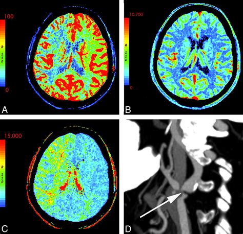 Evaluation Of Ct Perfusion In The Setting Of Cerebral Ischemia
