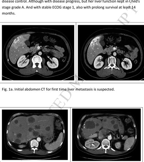 Post Partial Hepatectomy With Liver Metastasis Progress But With