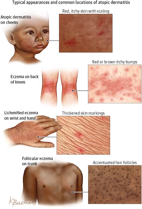 Atopic Dermatitis Allergy And Clinical Immunology Jama Dermatology