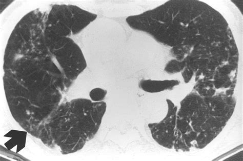 Radiographic And Ct Findings Of Nontuberculous Mycobacterial Pulmonary