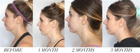 Before And After Coolsculpting Double Chin Area 90 Day Results