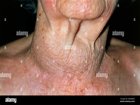 Thyroid Cancer View Of The Swollen Neck Of A 94 Year Old Woman Caused