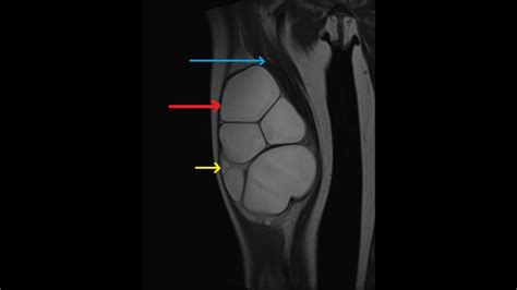 Hydatid Cyst Of Thigh Eurorad