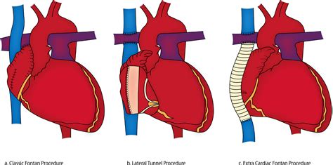 Perioperative Management Of The Fontan Patient For Cardiac And