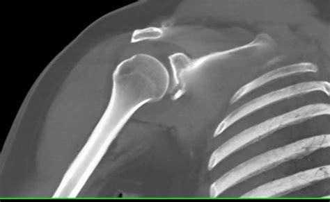 Fracture Of Inferior Rim Of The Glenoid Trauma Case Studies Ctisus