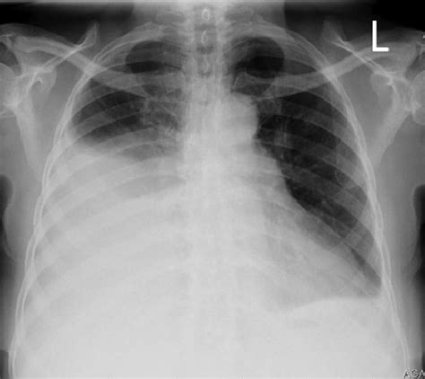 Chest X Ray Showing Large Right Sided Pleural Effusion Download Sexiz Pix