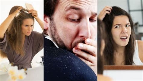 How To Get Rid Of Dandruff Without Shampoo Home Remedies