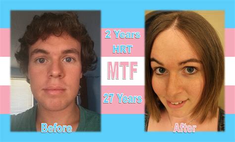 Mtf 2 Years Of Hrt 27 Years Old Before And After Transtimelines