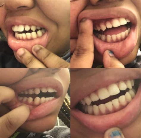 How To Know If We Need Braces Do You Need Braces 4 Ways You Can Tell
