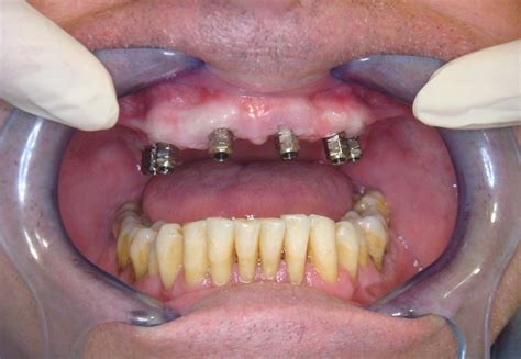 Caso clínico de uso de implantes dentales Medical Cañada