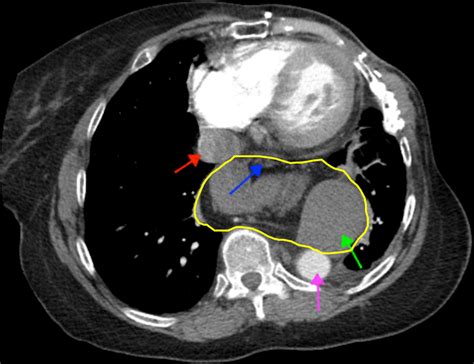 Hiatal Hernia On Ct Scan Images And Photos Finder