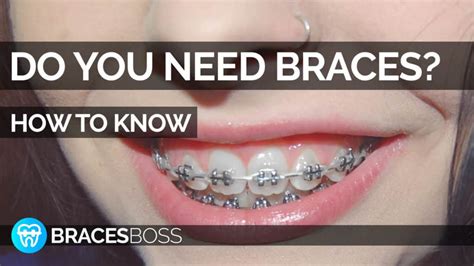 Do I Need Braces How To Know And What To Do 2021 Bracesboss