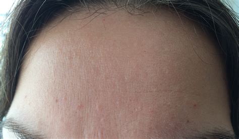 Small Flesh Colored Bumps On Forehead And Hairline Adult