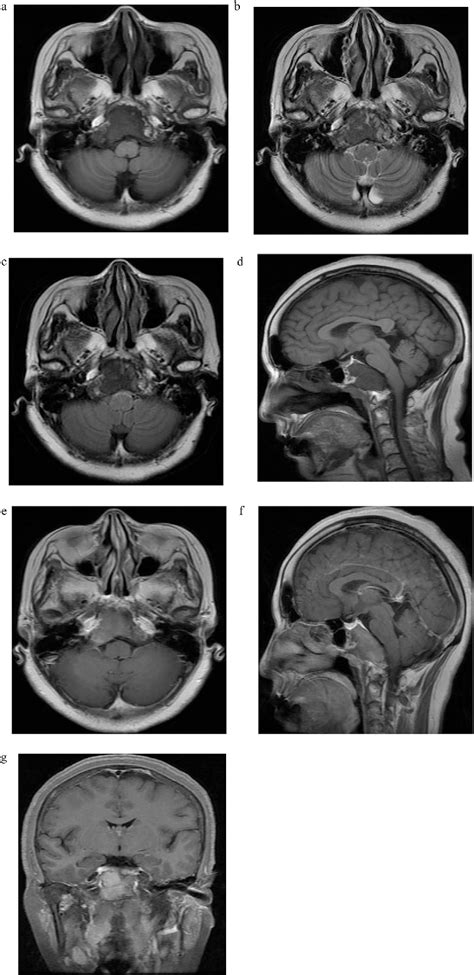 Figure 2 From Calcifying Fibrous Tumor Of The Clivus Presenting In An