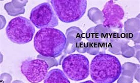 American Society Of Hematology Releases New Guidelines For Treating Aml