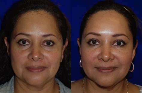 Facial Fillers Botox And Injectable Fillers At Artemedica