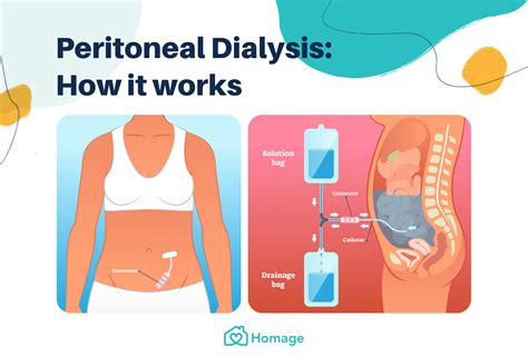 A Complete Guide To Peritoneal Dialysis In Singapore Homage