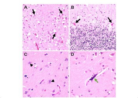 Figure E Representative Histologic Brain Autopsy Findings In Patients