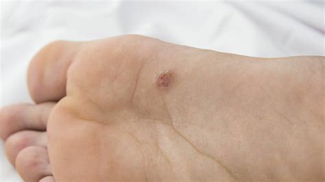 Plantar Warts Or Verrucae Are Caused By Womens Health
