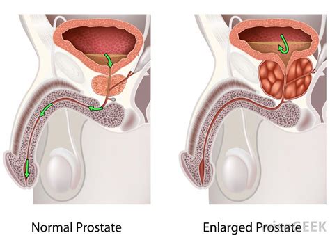Sign up for our health tip of the day newsletter, and receive daily tips that will help you live your healthiest life. What Is the Prostate Gland? (with pictures)