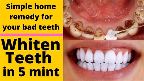 How To Whiten Your Teeth At Home Fast With This Simple Remedy Youtube