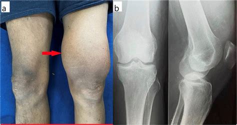 A Showing Left Knee Swelling 1b Showing Knee Radiograph With Medial
