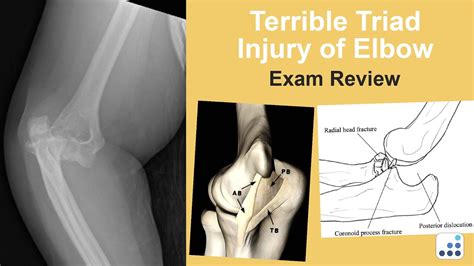 Terrible Triad Injury Of Elbow Exam Review Mark S Cohen Md Youtube