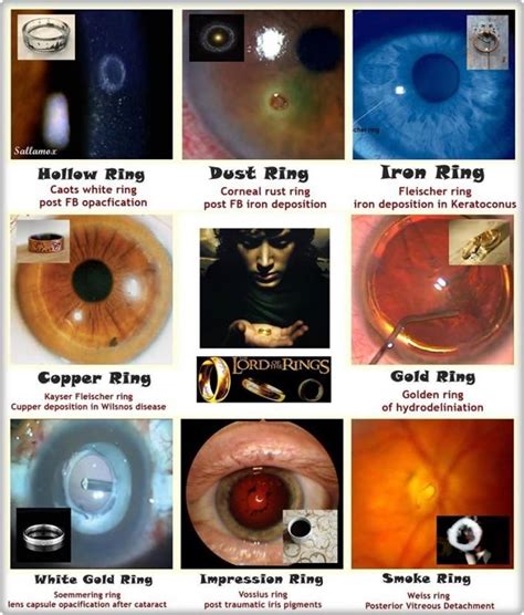 Rings Ophthalmology Attachmentphpattachmentid2836andd