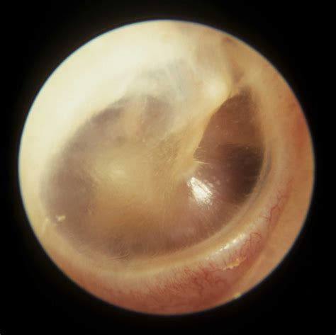 Otitis Media