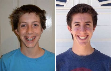 114 Incredible Before And After Transformations Of People Who Wore Braces