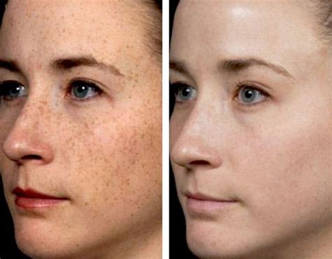 Fractional Laser Resurfacing Beverly Hills Spots On Face Age Spots