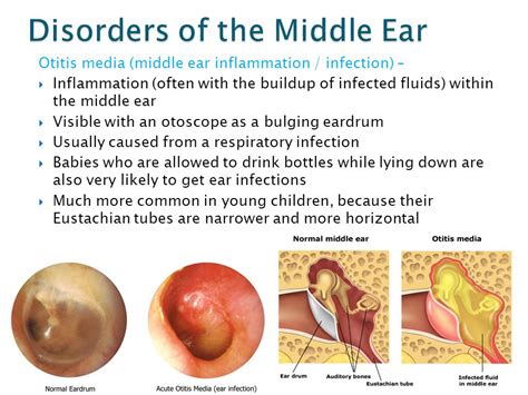 Middle Ear Inflammation Symptoms Adults Middle Infection Bubbles