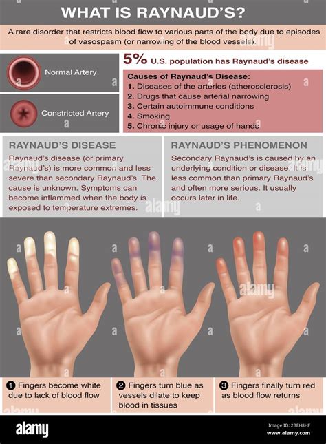 Raynauds Disease Disease Reference Guide Porn Sex Picture