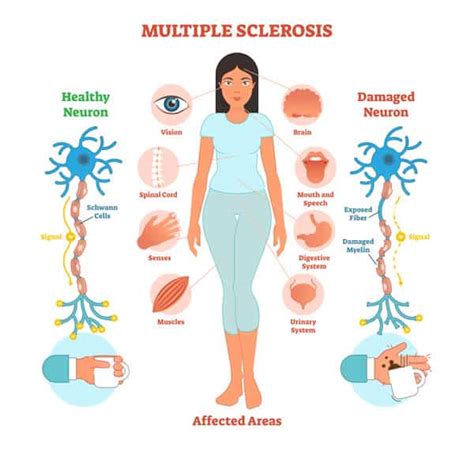 Massage Therapy Considerations For Multiple Sclerosis Patients Massage Professionals Update