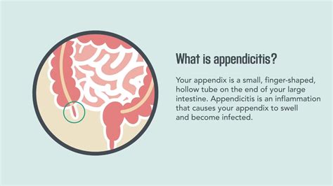 Appendicitis Symptoms Causes Diagnosis Treatment Vrogue Co
