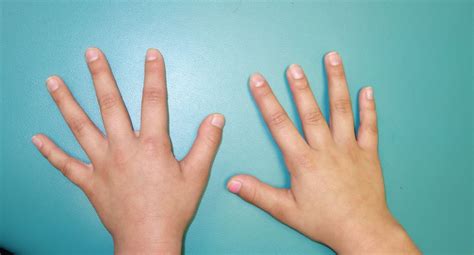 Short Fingers Brachydactyly Congenital Hand And Arm Differences