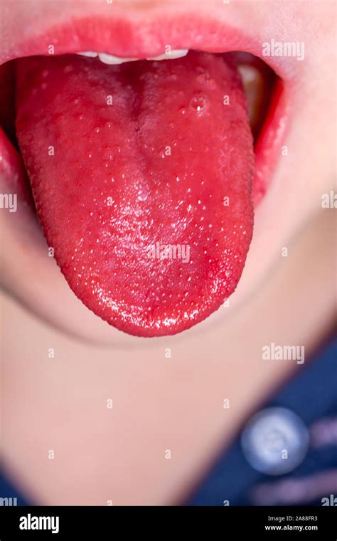 Strawberry Tongue Child High Resolution Stock Photography And Images