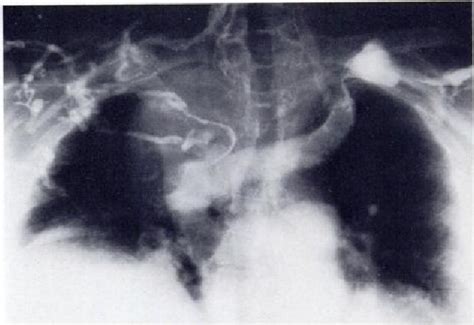Figure 4 From Superior Vena Caval System Obstruction Caused By Benign