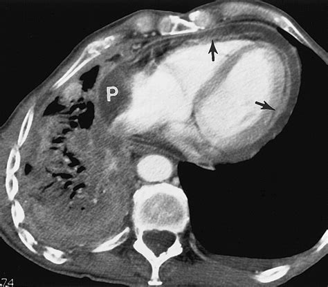 Metastatic Involvement Of The Heart And Pericardium Ct And Mr Imaging