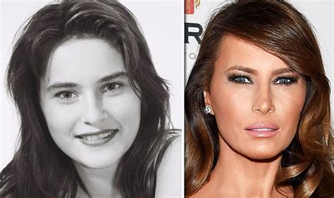 melania trump £12 000 plastic surgery before and after surgeon comments on possible work