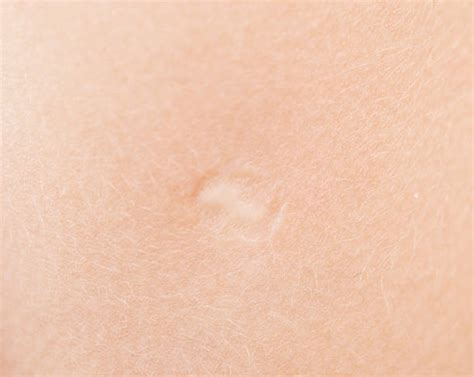 Smallpox Scars Stock Photos Pictures And Royalty Free Images Istock
