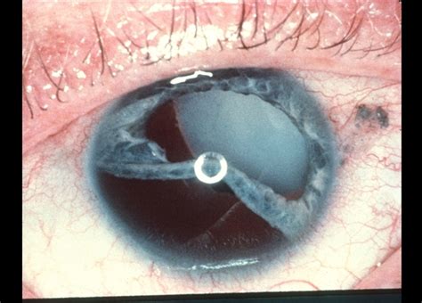 Traumatic Lens Dislocation Retina Image Bank