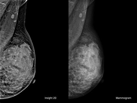 High Definition Breast Tomosynthesis