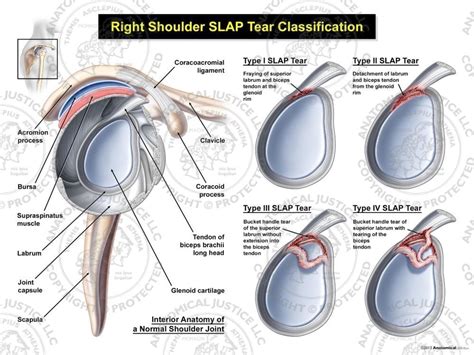 This cartilage encircles the glenoid, a cavity in the shoulder blade. Right SLAP Tear Classification