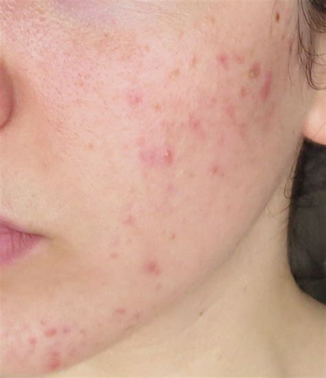 My Skins Journey Week 33 Banish Acne Scars