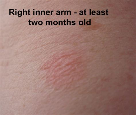 Round Rash On Arm Pictures Photos