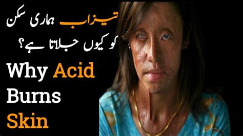 Why Acid Burns Skin How Acid Burn Skin Youtube