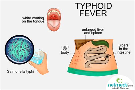 Typhoid Causes Symptoms And Treatment Netmeds